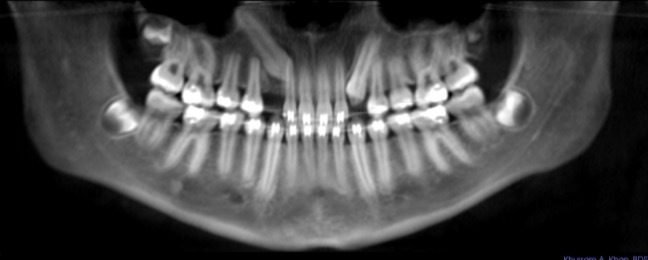 Impacted Canine Teeth
